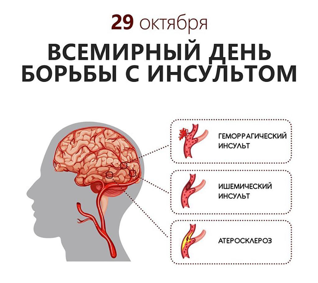 Октябрь – месяц профилактики инсульта